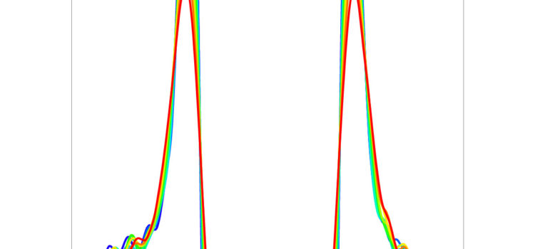 An eye on carrier distribution in graphene with the help of a superconductor